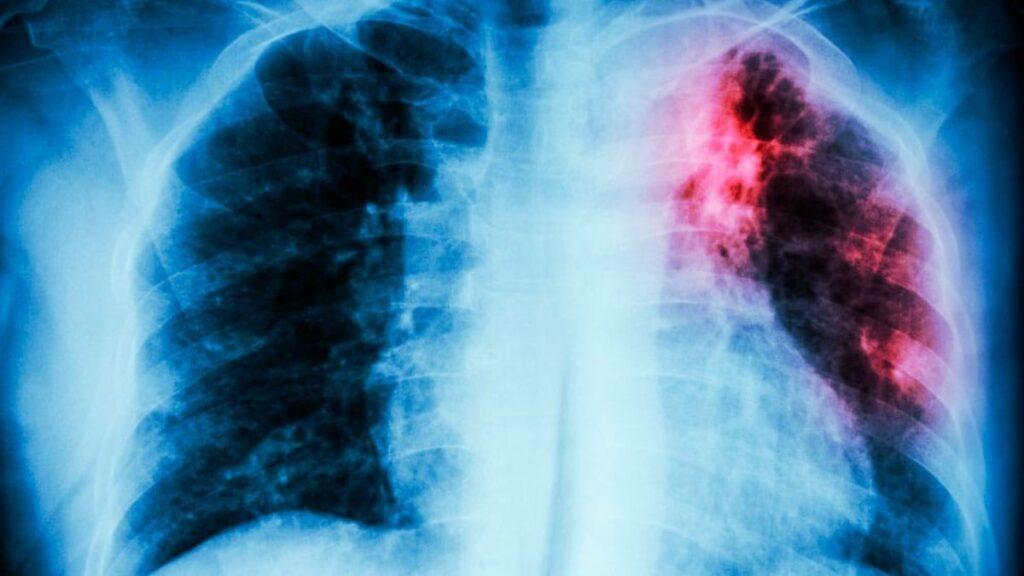 Chest X-ray Showing a Red-highlighted Lesion in the Right Upper Lung with Surrounding Hazy Opacity on the Left Side of the Image. - Glen Facturero